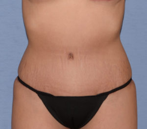 Tummy Tuck