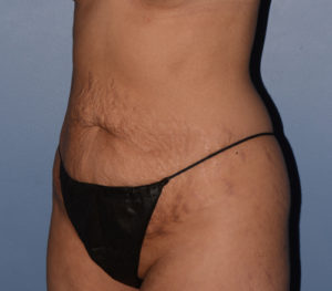 Tummy Tuck