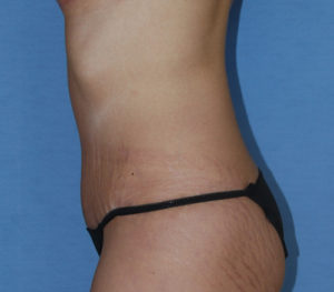 Tummy Tuck