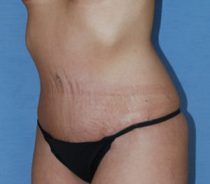 Tummy Tuck