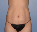Tummy Tuck