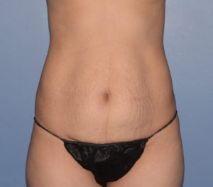 Tummy Tuck