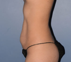 Tummy Tuck