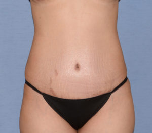 Tummy Tuck