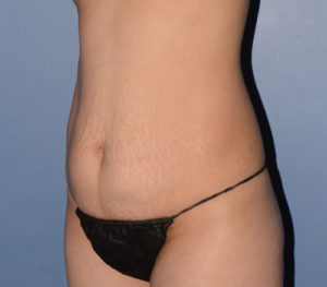 Tummy Tuck