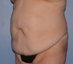 Tummy Tuck