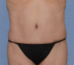 Tummy Tuck