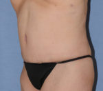 Tummy Tuck