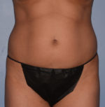 Liposuction