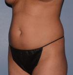 Liposuction