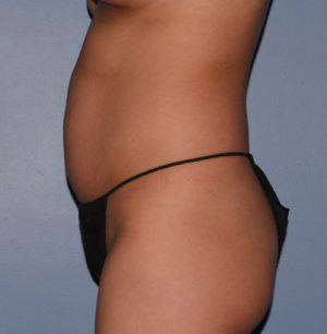 Liposuction