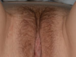 Clitoral Hood Reduction