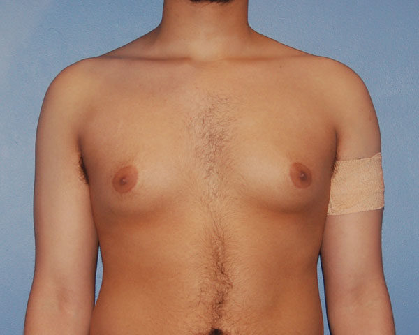 Male Breast Reduction Gynecomastia