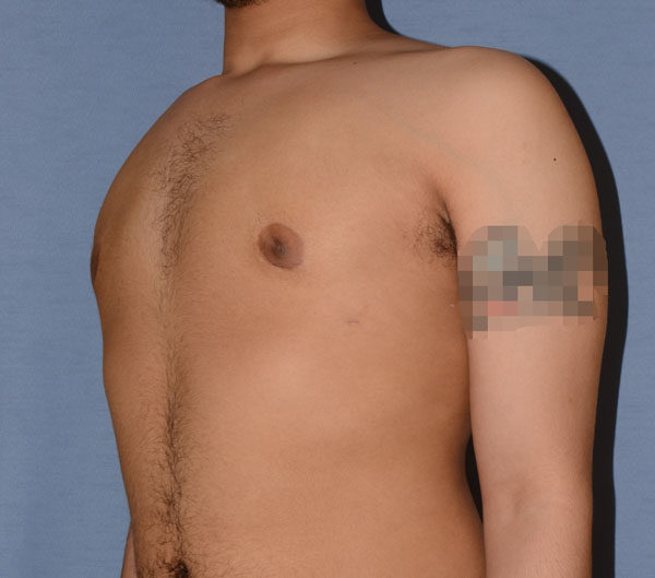 Male Breast Reduction Gynecomastia