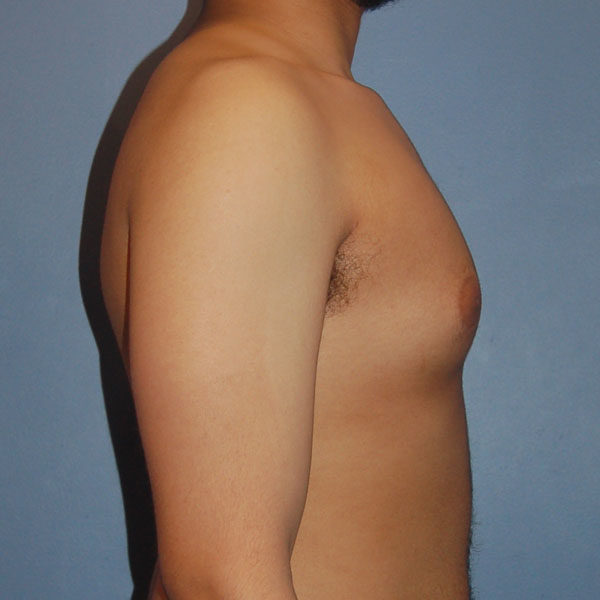 Male Breast Reduction Gynecomastia