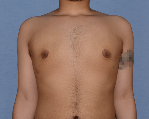 Male Breast Reduction Gynecomastia