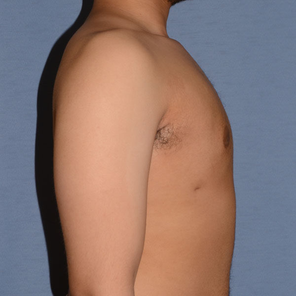 Male Breast Reduction Gynecomastia