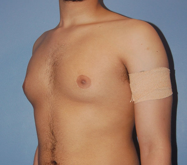 Male Breast Reduction Gynecomastia