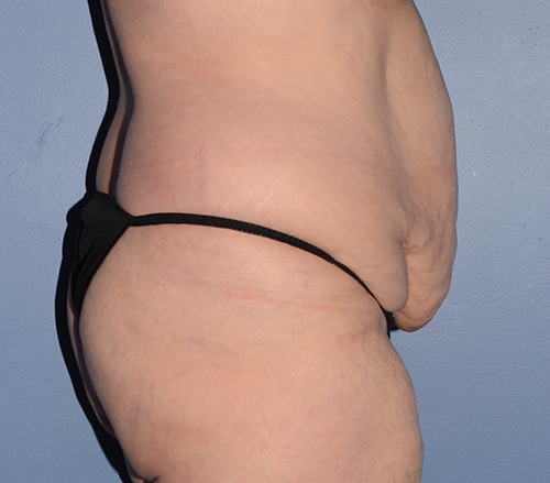 Tummy Tuck