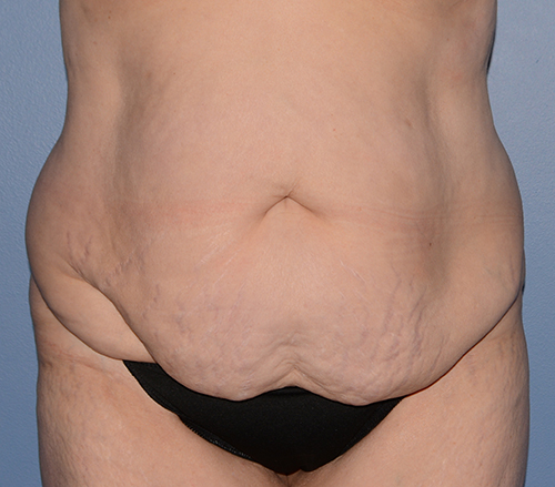 Tummy Tuck