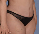 Tummy Tuck
