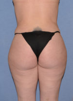 Liposuction