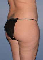 Liposuction