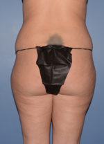 Liposuction