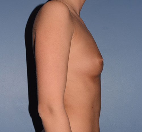 Breast Augmentation Implants