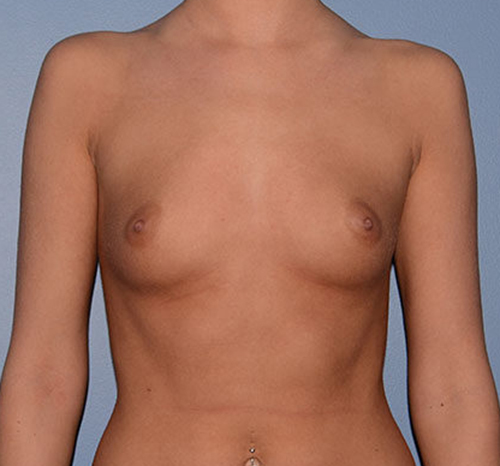 Breast Augmentation Implants