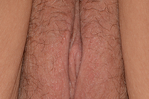 Clitoral Hood Reduction