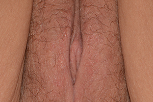 Clitoral Hood Reduction