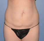 Tummy Tuck