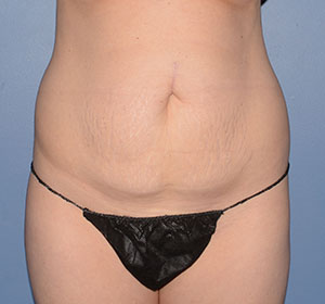 Tummy Tuck