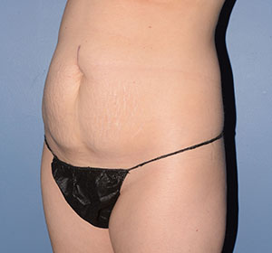 Tummy Tuck