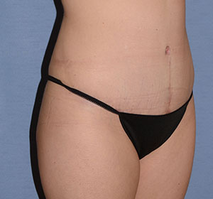 Tummy Tuck