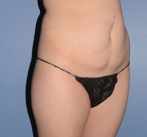 Tummy Tuck