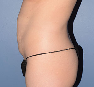 Tummy Tuck