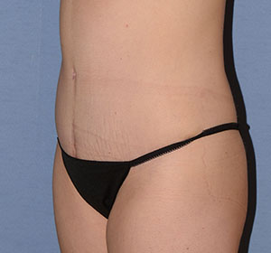 Tummy Tuck