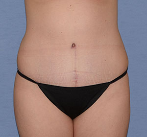 Tummy Tuck