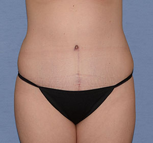 Tummy Tuck