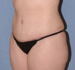 Tummy Tuck
