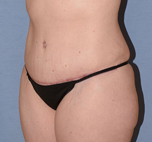 Tummy Tuck