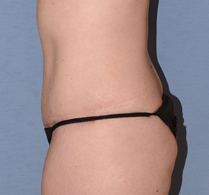 Tummy Tuck