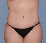 Tummy Tuck