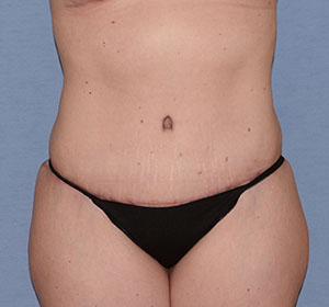Tummy Tuck