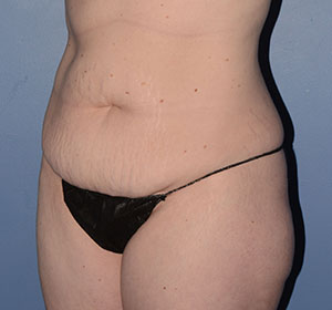 Tummy Tuck