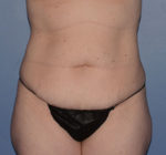 Tummy Tuck