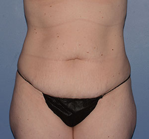 Tummy Tuck