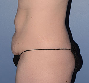 Tummy Tuck